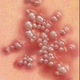 Illustration for article titled obat herpes penyakit kulit
